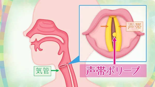 Official髭男dismが活動休止したのは藤原の病気が原因？声帯ポリープの症状ってどんななの？