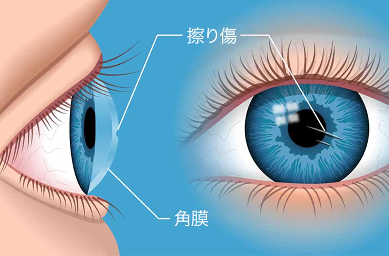 MAMAMOOフィインは怪我に悩まされている?花火での目の負傷は大丈夫だったの?
