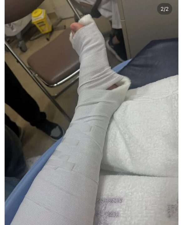 ONE OK ROCK(ワンオク)のTAKAが骨折の経過報告、レントゲン写真を公開。